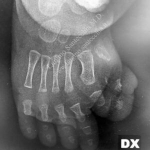 Radiografia (raggi X) di un piede destro (DX) di bambino con polidattilia radiale grave dell'avampiede. L'immagine mostra ossa metatarsali e falangi, evidenziando una malformazione con fusione (sindattilia) e deviazione in valgismo delle prime due dita (alluce e dita accessorie), con presenza di strutture ossee soprannumerarie (polidattilia).