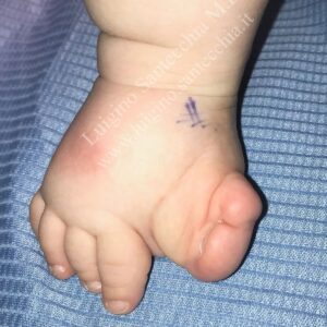 Immagine clinica del piede destro di un bambino, vista laterale mediale, che mostra una malformazione complessa da polidattilia radiale grave. Si notano l'avampiede ingrossato e la fusione (sindattilia) in valgismo delle due dita più interne (alluce e suo duplicato), con il resto delle dita più piccole separate. È visibile un segno chirurgico di marcatura blu sulla pelle.