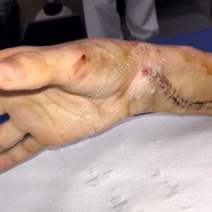 emiplegia-spastica immagine post operatoria 2