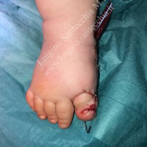 Immagine clinica del piede di un bambino subito dopo l'intervento chirurgico di correzione della polidattilia radiale. Il piede ricostruito mostra cinque dita. La zona dell'alluce presenta punti di sutura chirurgici e un filo di Kirschner (K-wire) sporgente per la stabilizzazione ossea temporanea post-intervento.