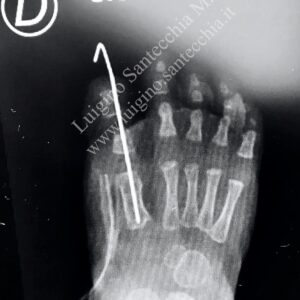 Radiografia (raggi X) post-operatoria del piede. L'immagine in bianco e nero mostra l'allineamento osseo corretto delle falangi e dei metatarsi. È ben visibile un lungo filo di Kirschner (K-wire) inserito nell'alluce, che attraversa la prima articolazione metatarso-falangea per mantenere la correzione e la stabilità scheletrica ("D" e "S.O." indicano rispettivamente la destra e l'iniziale di Sala Operatoria).