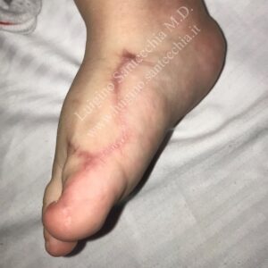Immagine clinica del piede di un bambino in fase di guarigione a distanza dall'intervento. La foto laterale mediale mostra l'alluce ben allineato e la presenza di una cicatrice chirurgica ben definita ma guarita che si estende lungo il dorso e il lato interno del piede (esito dell'osteotomia e rimozione dell'eccesso osseo/tessuto).