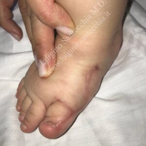 Immagine clinica del piede di un bambino durante un controllo post-operatorio. Il piede appare ben formato con cinque dita allineate. Sono visibili le cicatrici chirurgiche guarite sul dorso e sul lato mediale del piede, che dimostrano la riuscita correzione della polidattilia radiale. Una mano adulta valuta la zona.